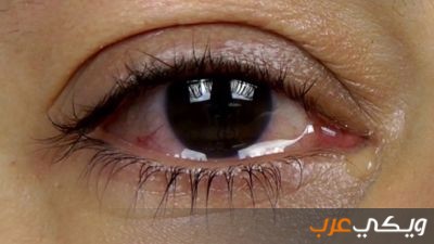 أسباب دموع العيون وطرق علاجها على موقع ويكي العرب