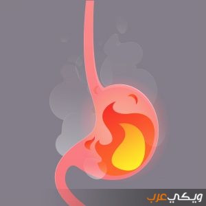 علاج حرقة المعدة