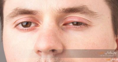 علاج التهاب جفن العين