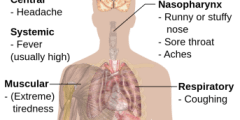أعراض مرض الإنفلونزا