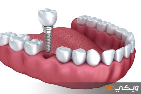 كل ما يتعلق بعمليات زراعة الأسنان
