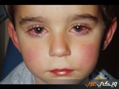 أعراض احمرار العيون عند الأطفال - ويكي عرب