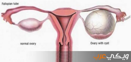 تكيسات المبيض وأهم أعراضه وأنواعه ويكي عرب