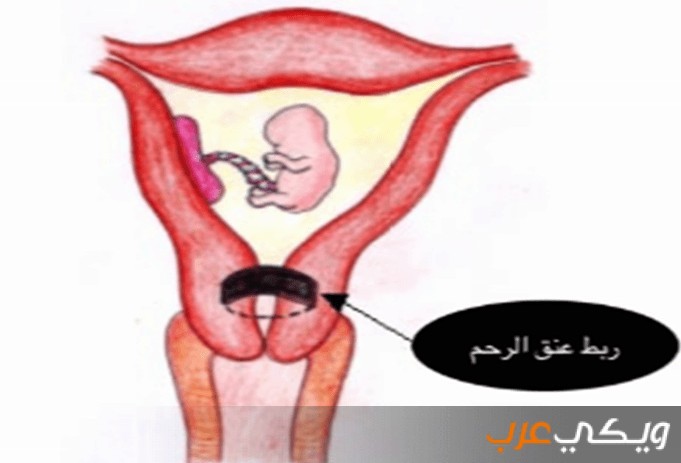 ما هي عملية ربط عنق الرحم و ما فوائدها ويكي عرب