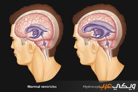 استسقاء الدماغ و آلية حدوثه و أسبابه و أعراضه