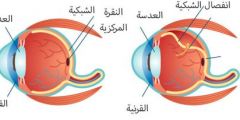 اعتلال الشبكية السكري أعراضه و مضاعفاته المتعددة و طرق الوقاية