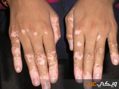 ما هو مرض البهاق الجلدي 