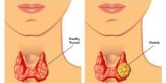 ما هي العقد الدرقية وأسباب ظهورها وطرق التشخيص والعلاج
