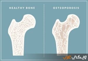 نبذة عن هشاشة العظام
