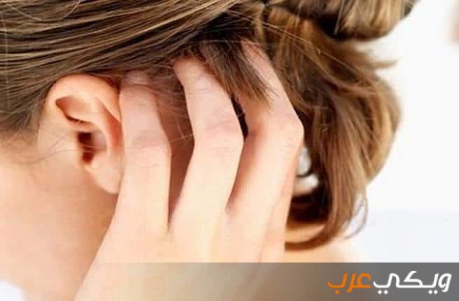 أعراض وعلاج التهاب فروة الرأس ويكي عرب