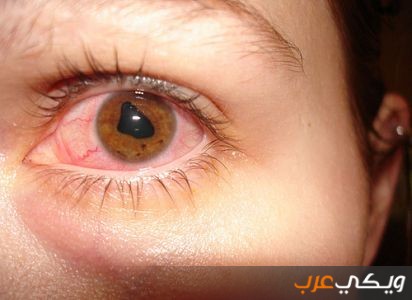 ما يجب معرفته عن التهاب قزحية العين - ويكي عرب