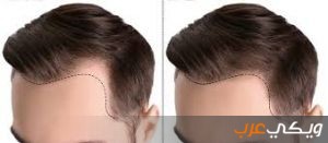 الفكرة الأساسية لعمليات زراعة الشعر