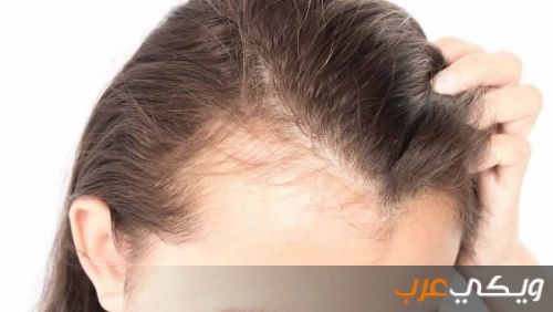 فوائد زراعة الشعر وأضرارها وأهم النصائح الهامة