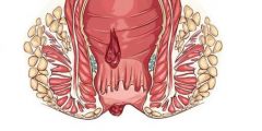 مرض البواسير أنواعه وطرق اكتشافه