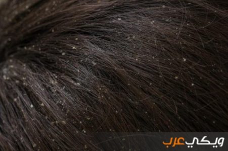 أسباب قشور الشعر وطرق علاجها ويكي عرب