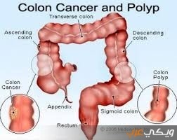 طريقة تنظيف القولون بالأعشاب ويكي عرب