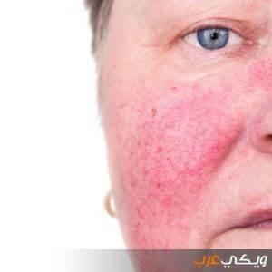 علاج مرض الوردية الجلدي ويكي عرب