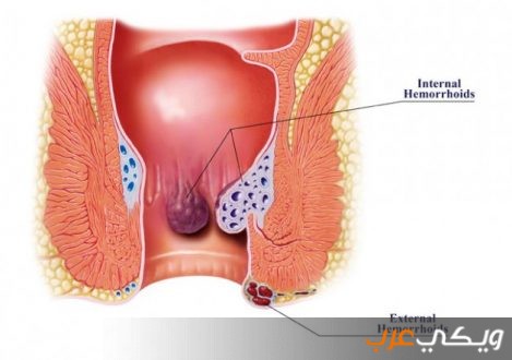 أعراض مرض الباسور