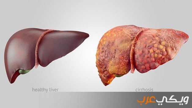 اعراض تليف الكبد وطرق العلاج