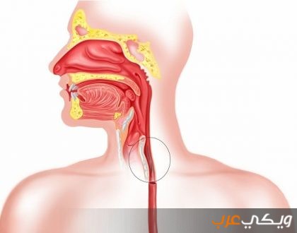 أعراض متلازمة تمزق الغشاء المخاطي