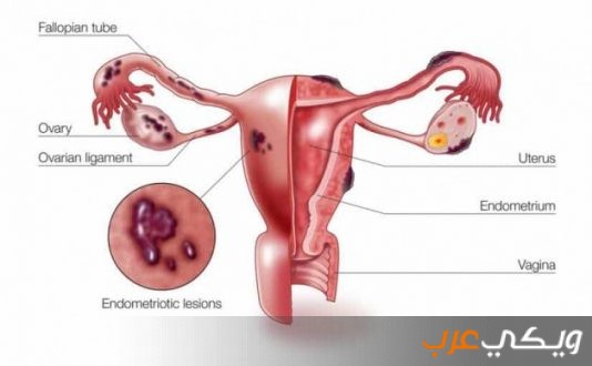 أعراض أمراض بطانة الرحم 